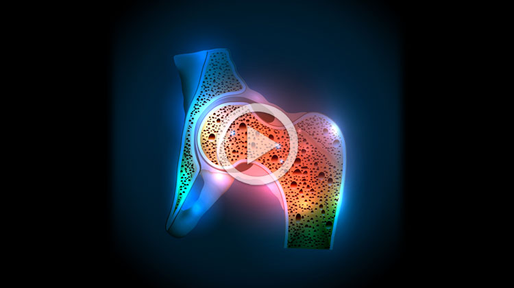 Osteoporóza a účinky magnetoterapie